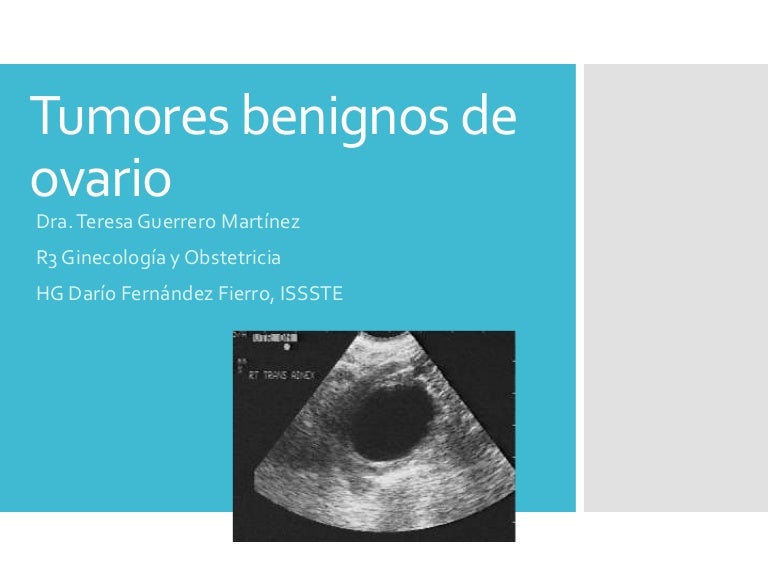 Quiste ovarico funcional sintomas